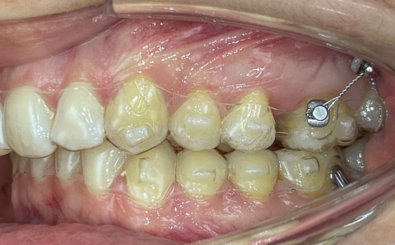 Orthodontie Minivis après traitement