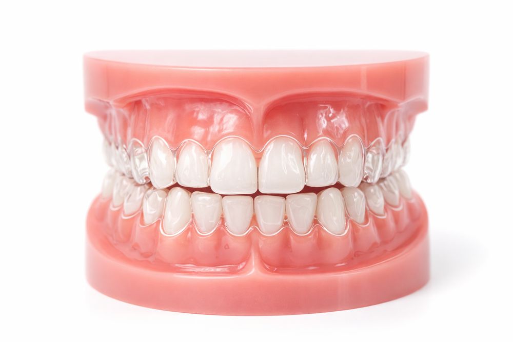 Aligneur transparent sur modèle dentaire