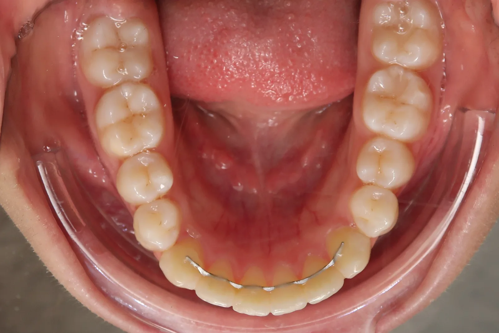 Fil de contention collé derrière les dents de l'arcade inférieure